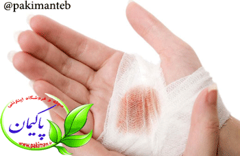 در هنگام سوختگی در منزل چیکار کنم