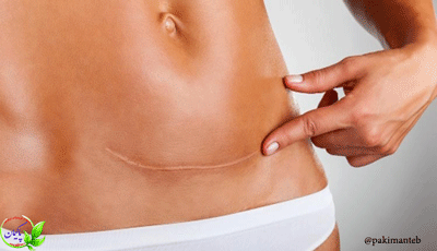 بهبود زخم سزارین